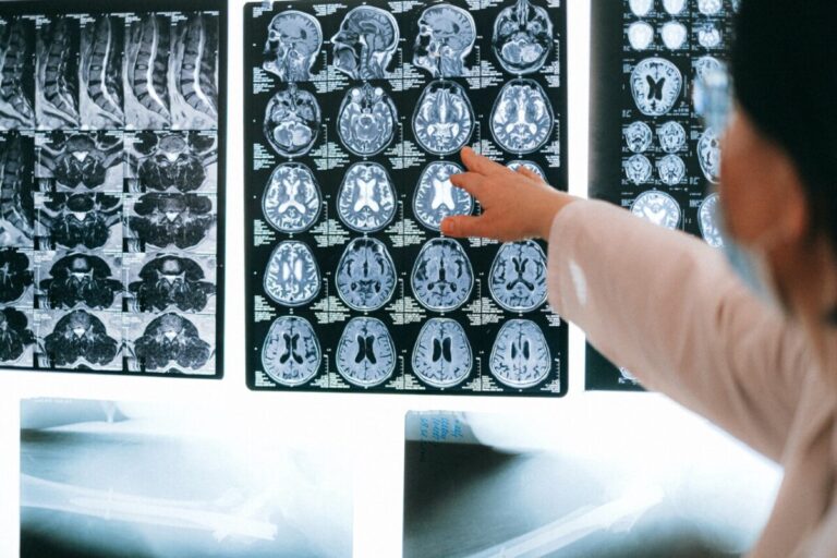 Un modelo matemático ayuda a explicar cómo circula la sangre por el cerebro